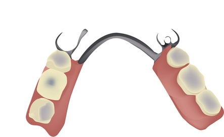 Teilprothese
